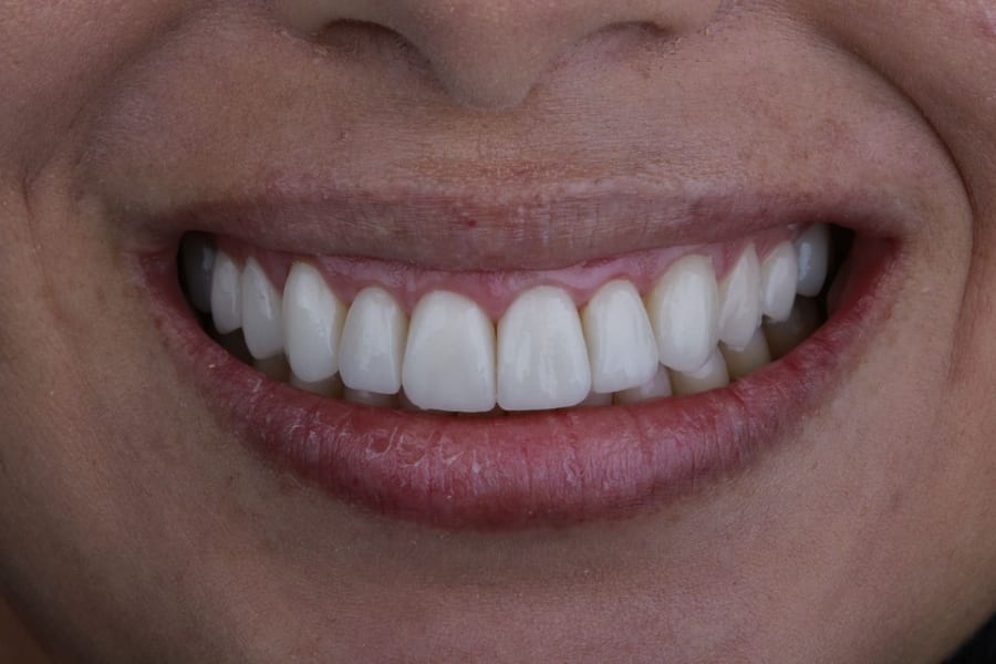 Antes del tratamiento: Armonización estética de sonrisa en R&V Dental, Palmares