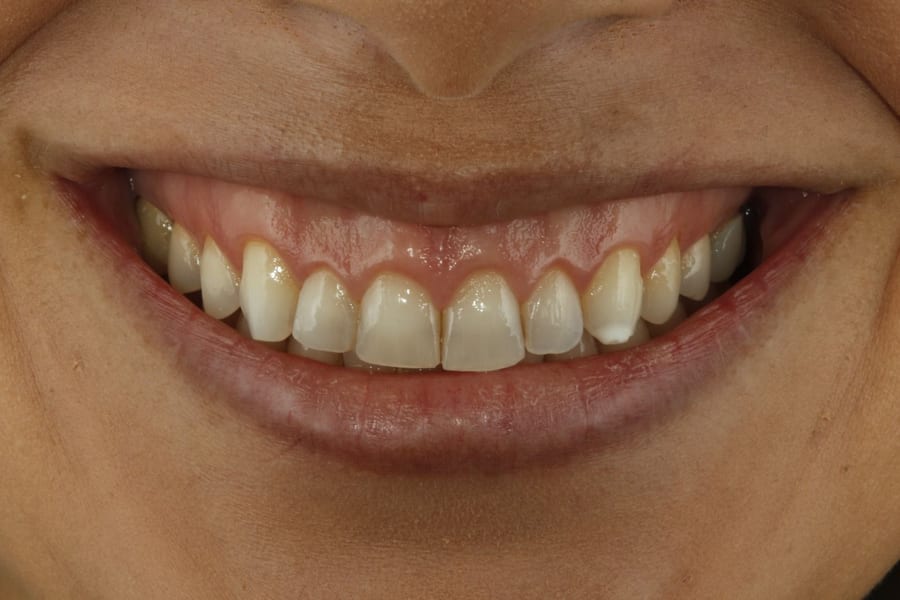 Después del tratamiento: Armonización estética de sonrisa en R&V Dental, Palmares
