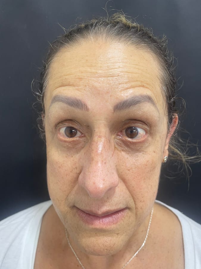 Antes del tratamiento: Botox en arrugas de la frente en R&V Dental, Palmares
