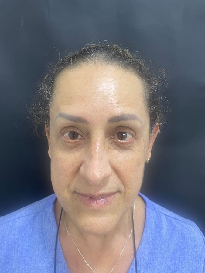 Después del tratamiento: Botox en arrugas de la frente en R&V Dental, Palmares