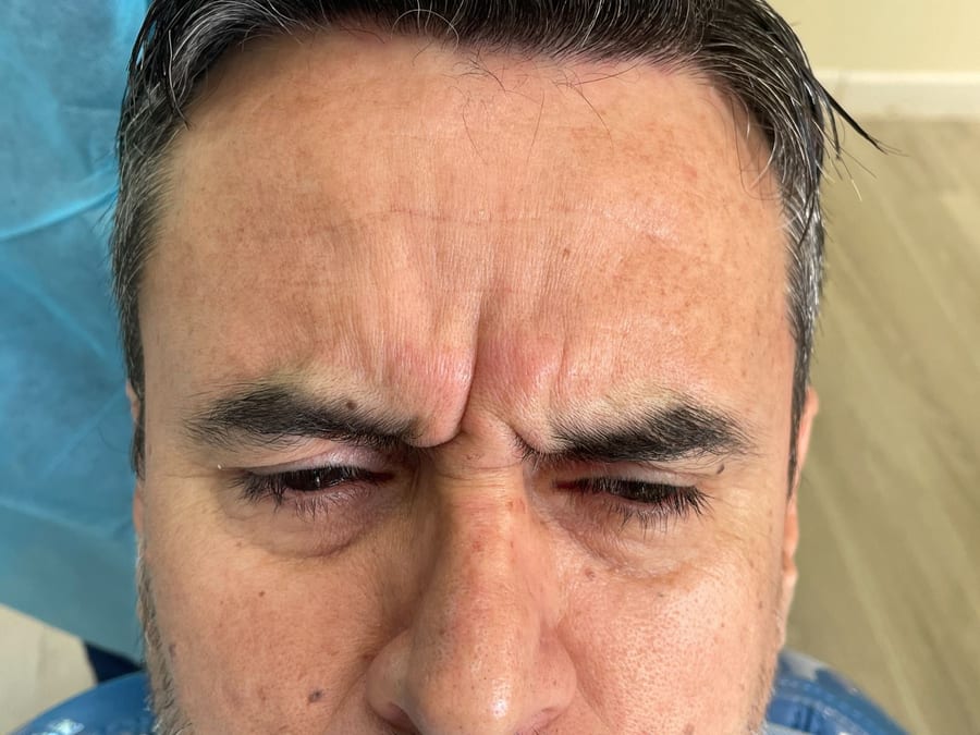Antes del tratamiento: Botox en líneas de la frente en R&V Dental, Palmares