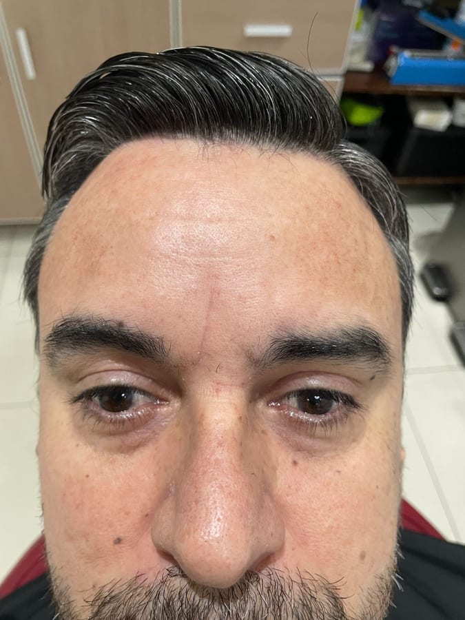 Después del tratamiento: Botox en líneas de la frente en R&V Dental, Palmares