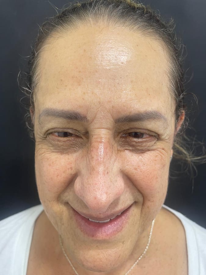 Antes del tratamiento: Botox en arrugas de la nariz en R&V Dental, Palmares