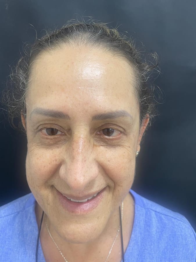 Después del tratamiento: Botox en arrugas de la nariz en R&V Dental, Palmares