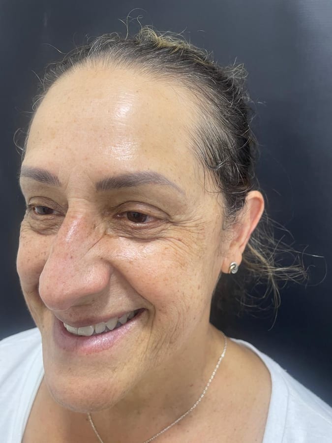 Antes del tratamiento: Botox en patas de gallo en R&V Dental, Palmares