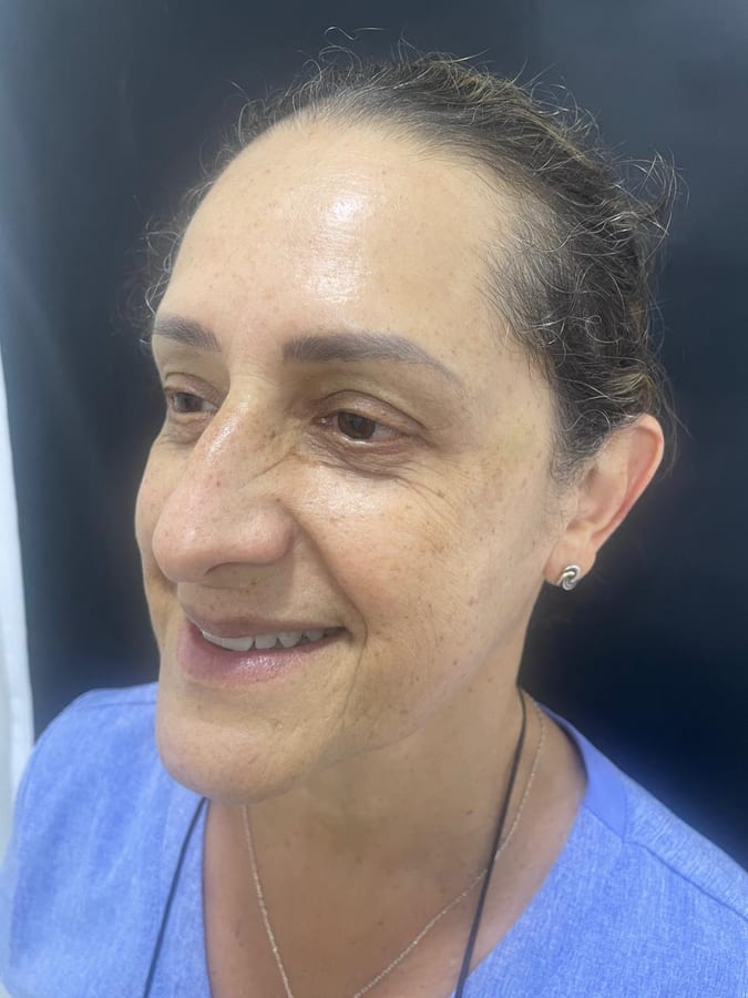 Después del tratamiento: Botox en patas de gallo en R&V Dental, Palmares