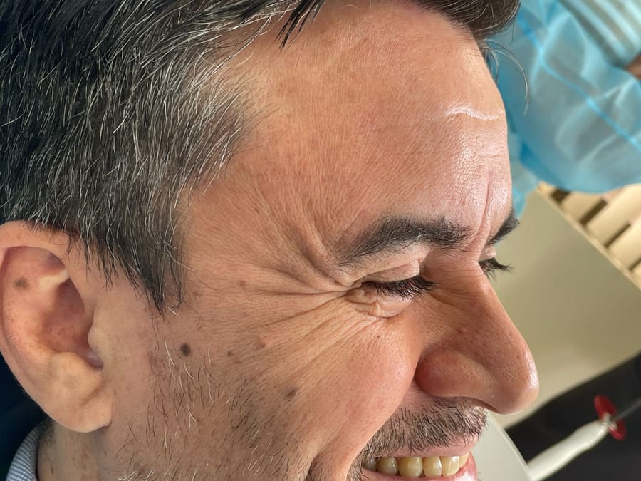 Antes del tratamiento: Botox para patas de gallo en R&V Dental, Palmares