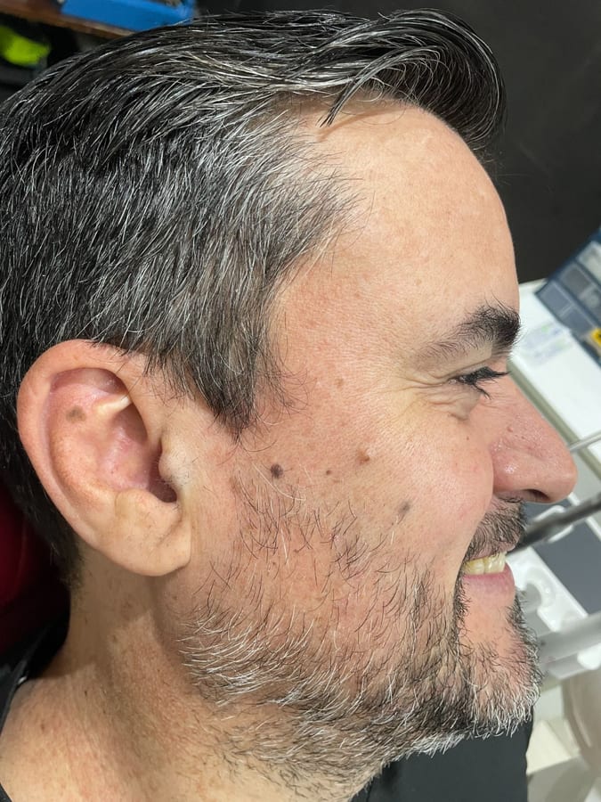 Después del tratamiento: Botox para patas de gallo en R&V Dental, Palmares