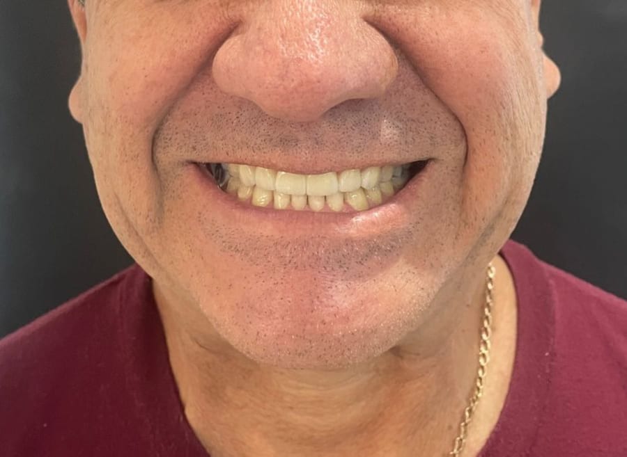 Antes del tratamiento: Rehabilitación estética con alta naturalidad en R&V Dental, Palmares