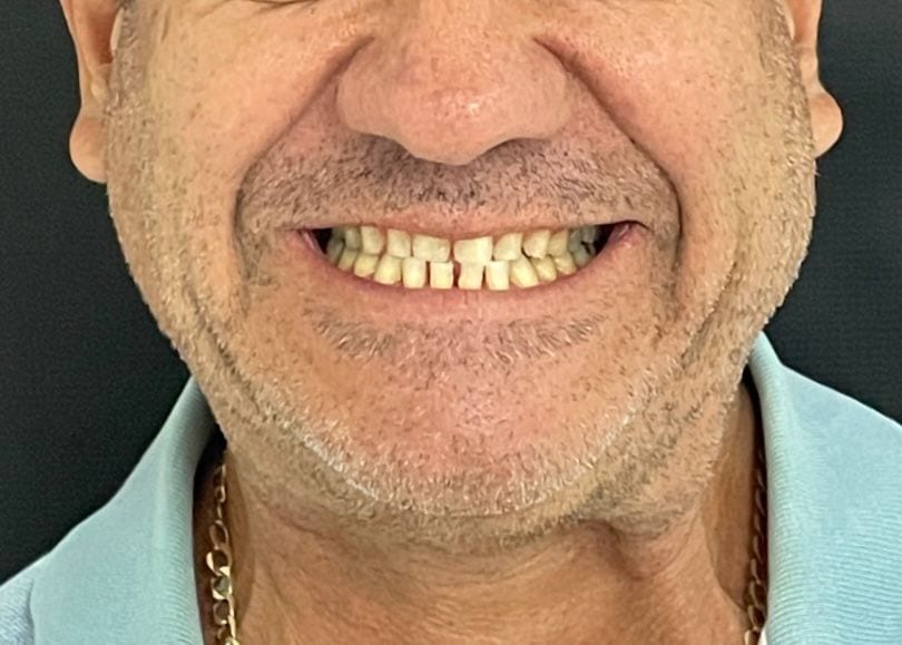 Después del tratamiento: Rehabilitación estética con alta naturalidad en R&V Dental, Palmares